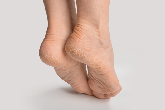 DRY SKIN ON FOOTS